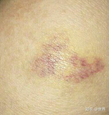 淤血能不能让蚊子吸走?