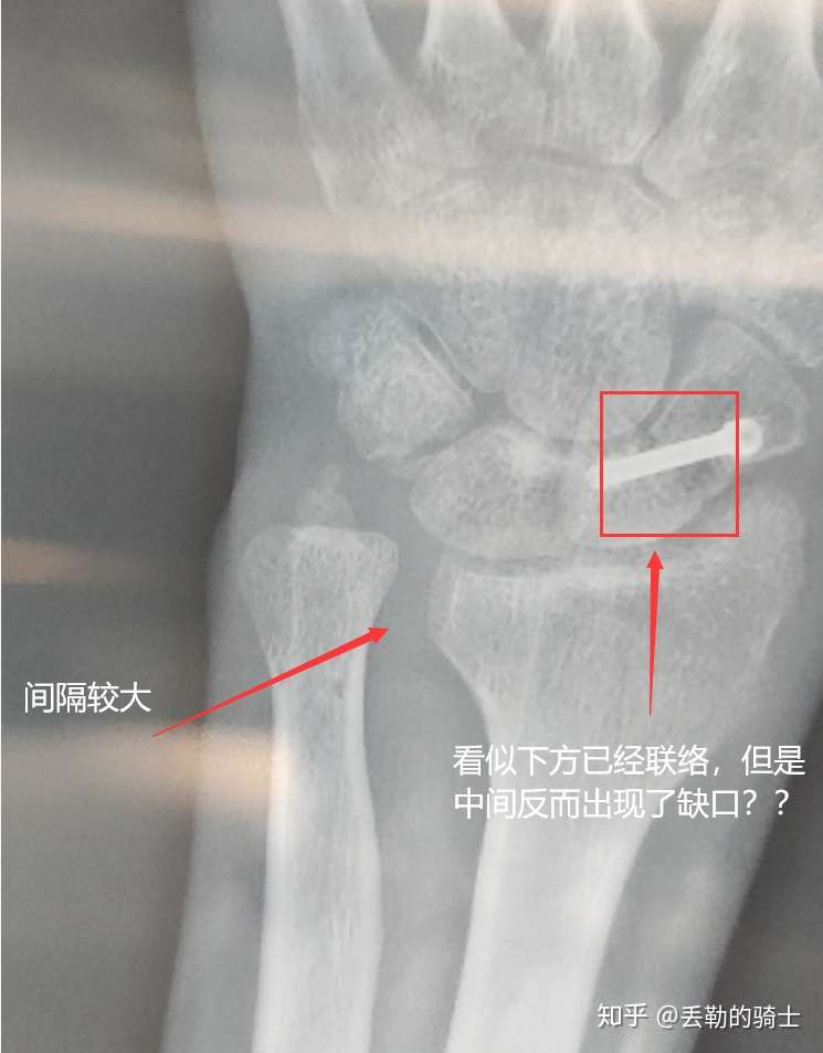 亲身经历 舟状骨 尺骨骨折 尺桡关节脱位 Tfcc损伤康复日记 知乎