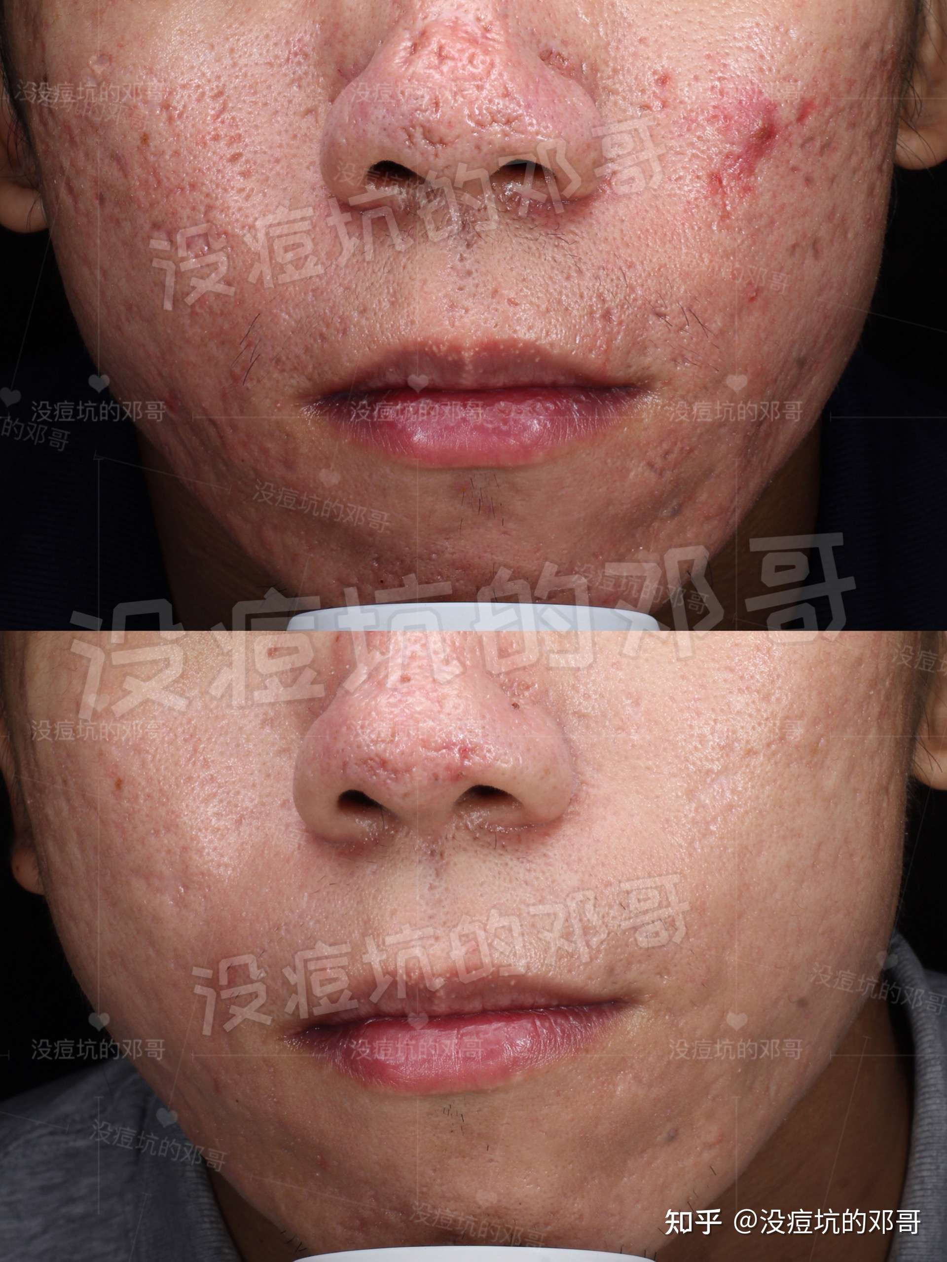 没痘坑的邓哥 的想法: 冰锥型77厢车型痘坑修复,做了8次点阵激