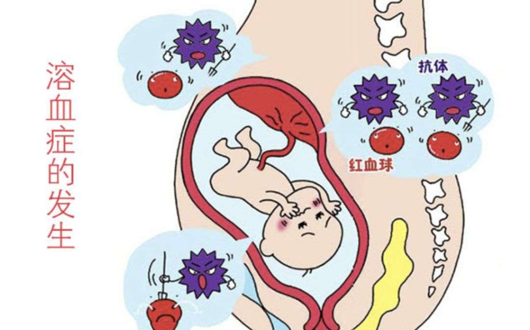 结婚跟血型有关系 3分钟带你认识新生儿溶血 知乎