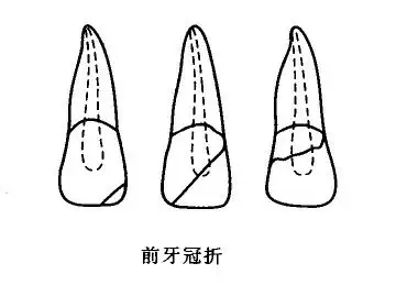 门牙磕掉一块补一补要多少钱