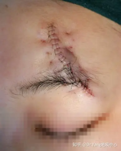 一例额眉部疤痕修复术