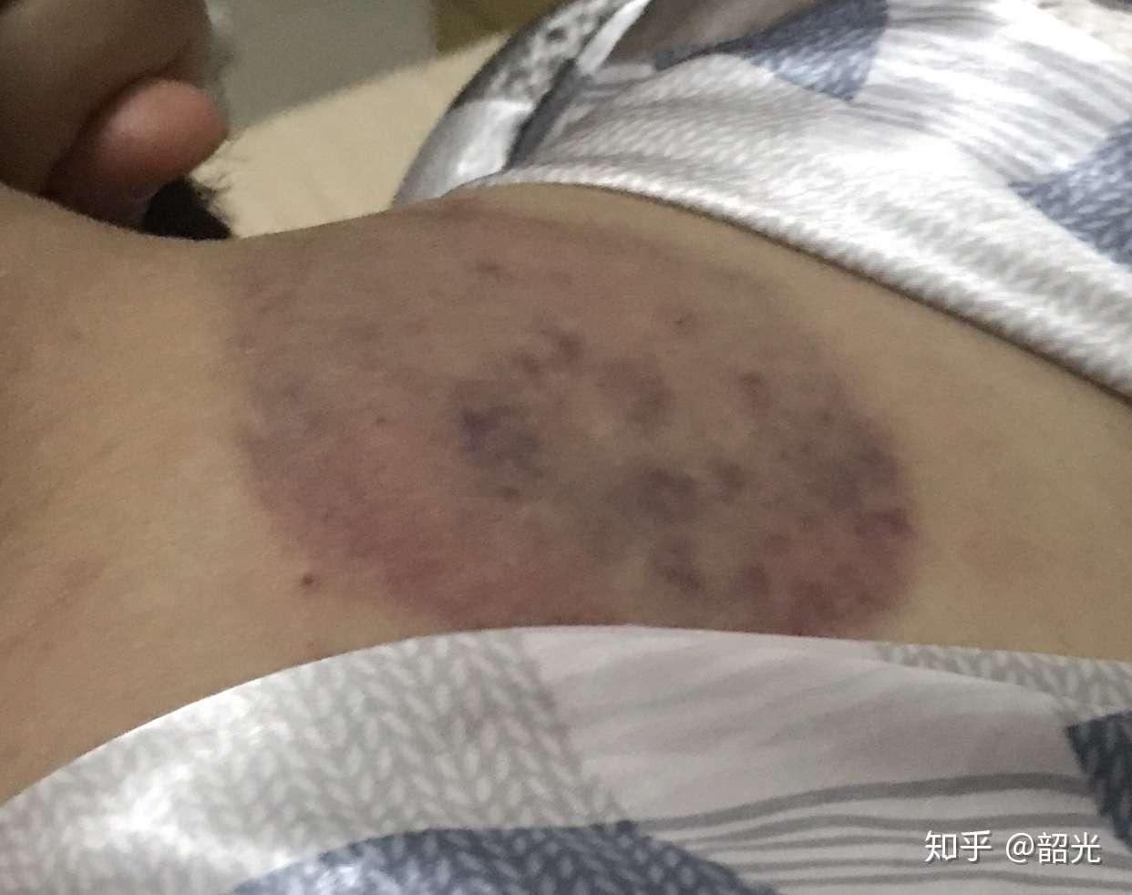 荨麻疹治疗过程分享 知乎