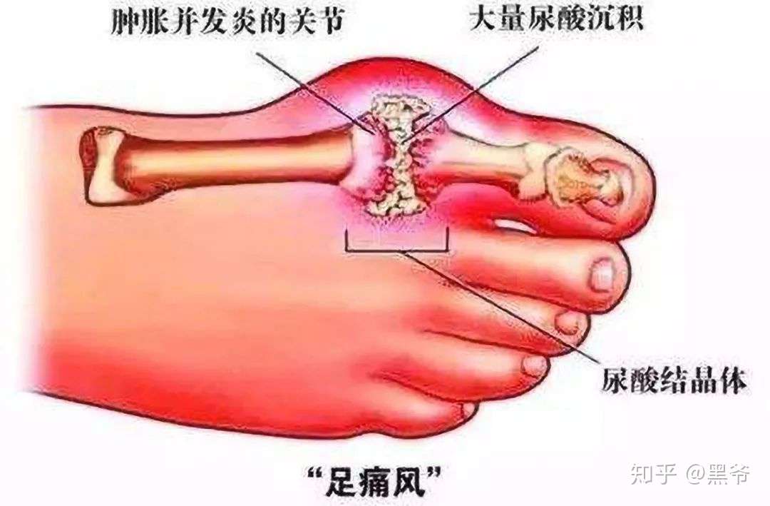 脚趾痛是痛风吗 先别急 认真了解一下 知乎