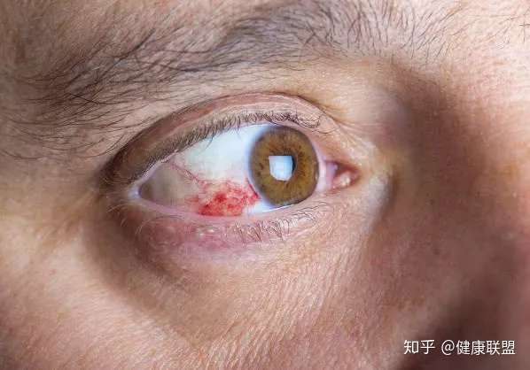 肝不好眼先知一旦眼睛有2种迹象很有可能是肝癌