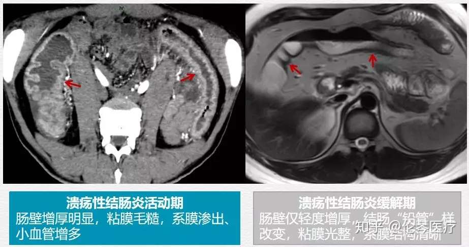 炎症性肠病为何需要影像学检查 看仁济医院教授怎么说 知乎