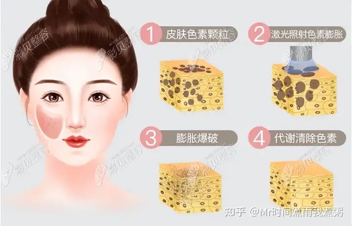 2022最新皮秒激光祛斑价目表：正规医院皮秒的价格贵的吓人~丨皮秒激光祛斑一般需要多少钱