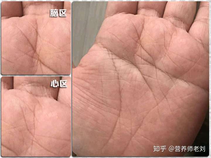 肿瘤体质的4个手掌特征