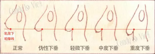 如何直观通俗说明纺锤胸和胸下垂的区别?