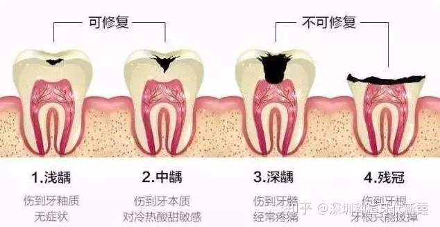什么是根管治疗 什么是牙齿打桩 你知道这二者的区别吗 知乎