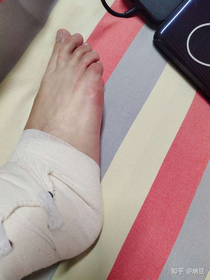 被开水烫伤后的皮肤变化与恢复