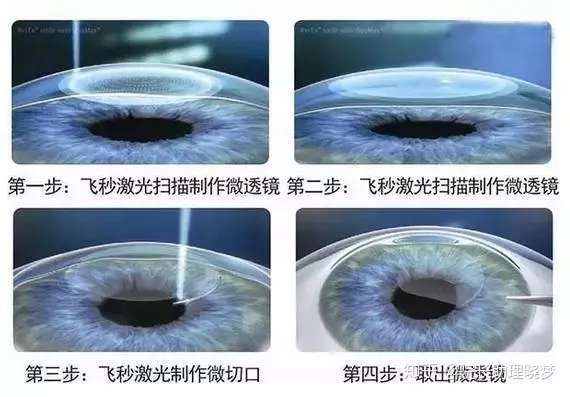 关于全飞秒激光手术 你想知道的全在这里了 知乎