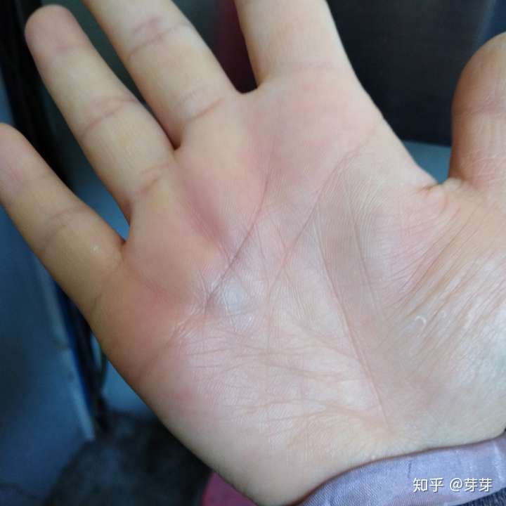 手掌隔三差五就会出现这样的深色斑块,按压有痛感,是什么原因啊?