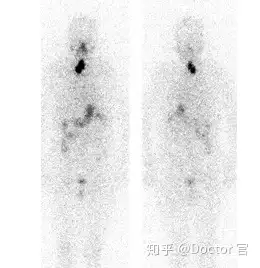 碘131全身显像正常图图片