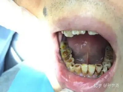 牙齿变黄,变黑:紫红色的槟榔汁液充满口腔各处不易清洁,时间长了,牙齿