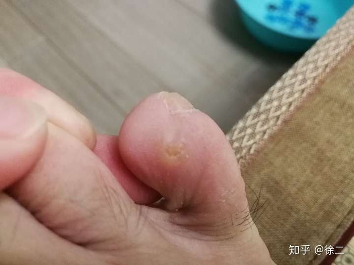 你是如何治好脚上长的鸡眼的