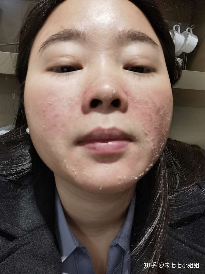 微针第二次 ,第三天晚上.