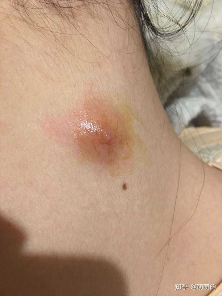 黑头大到直接挤出来是什么感受