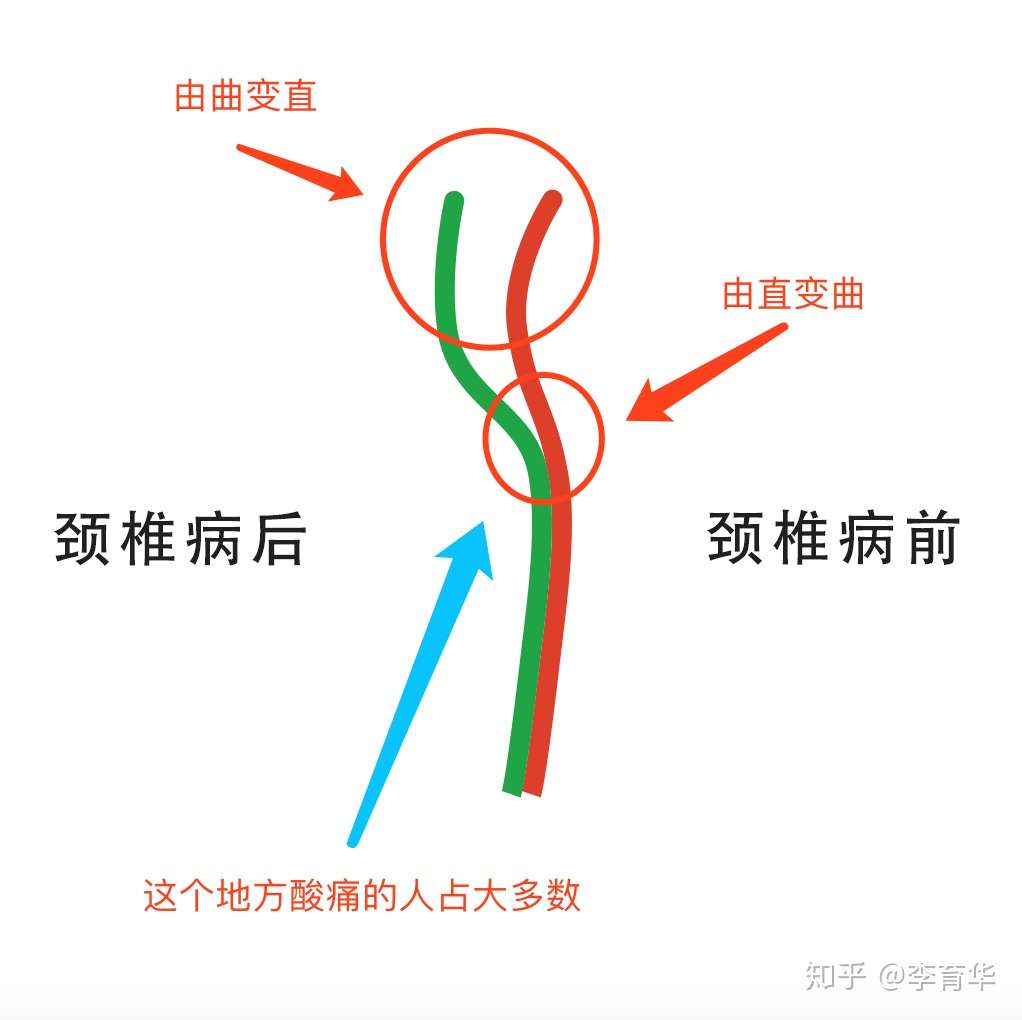 我的颈椎病治疗探索 微信群图文实录 知乎