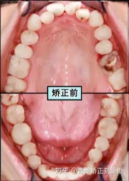 上海牙齒矯正地包天亂齒重獲新生