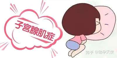 子宫腺肌症到底是什么？影响怀孕么？