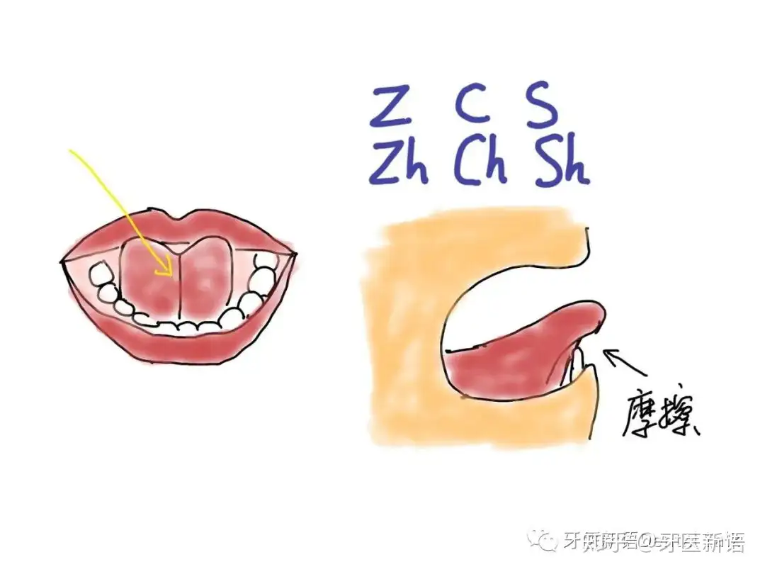 嘴里的两条“带” 之舌系带上唇系带过短- 知乎