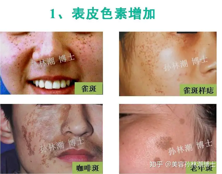 万万没想到（根治色斑最有效的方法）色斑怎么治疗最好的方法，色斑如何分类？哪些色斑好治？哪些不好治？，