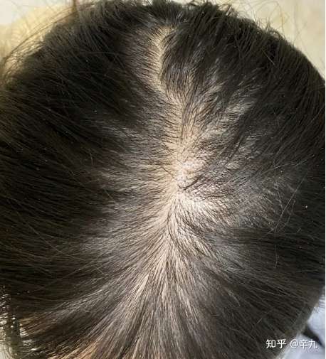 女生头顶头发少是什么体验?