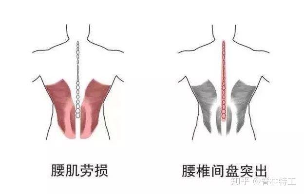 【腰痛自检和治疗】 椎间盘突出 vs 腰肌劳损