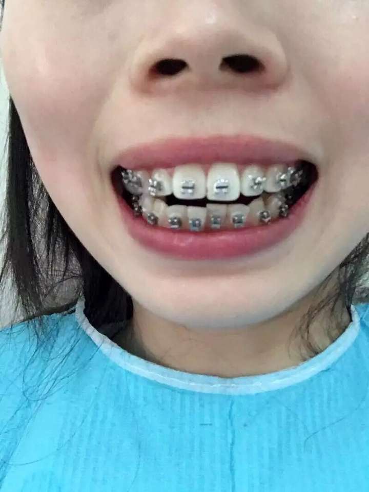 9岁门牙龅牙图片