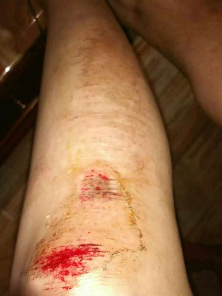 求解如何治疗膝盖擦伤留下大面积疤痕?