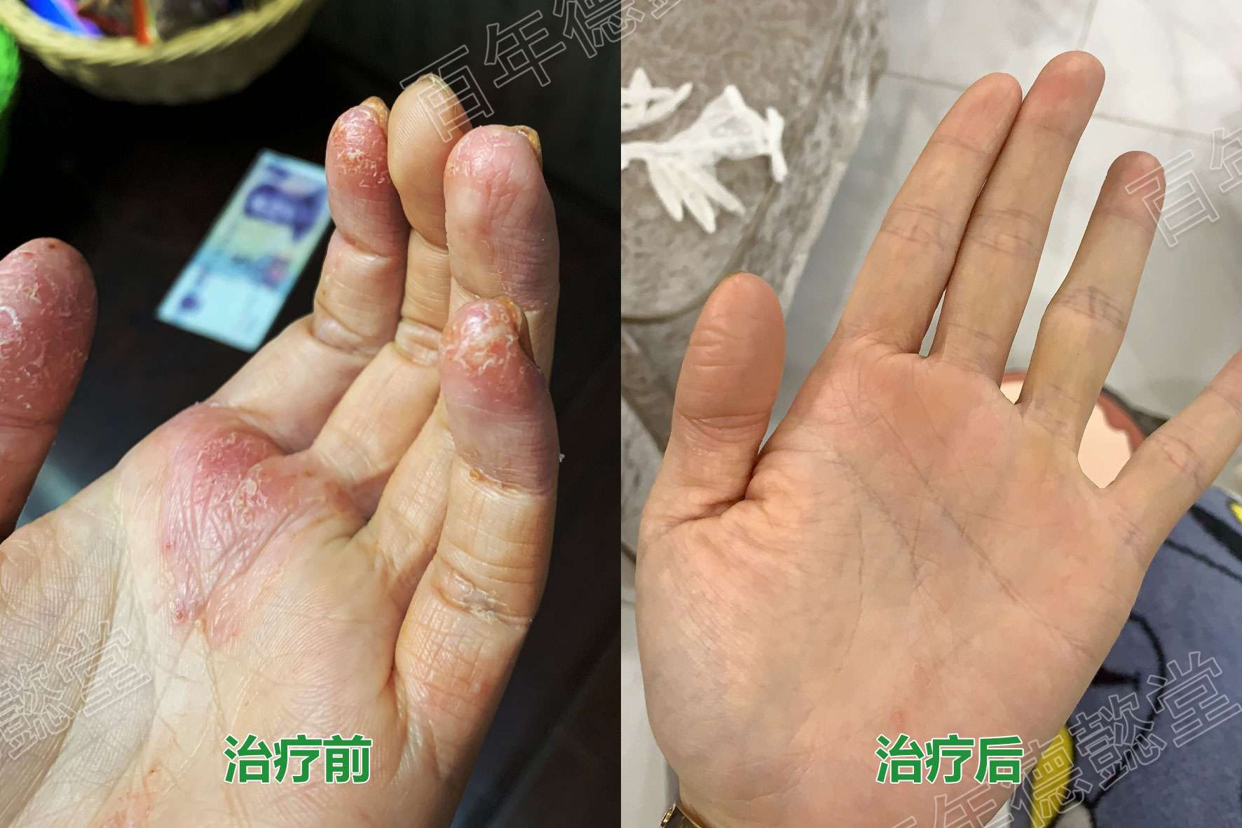 李志忠講皮膚 的想法: 掌蹠膿皰病多因稟賦不足,肺脾失調,運化