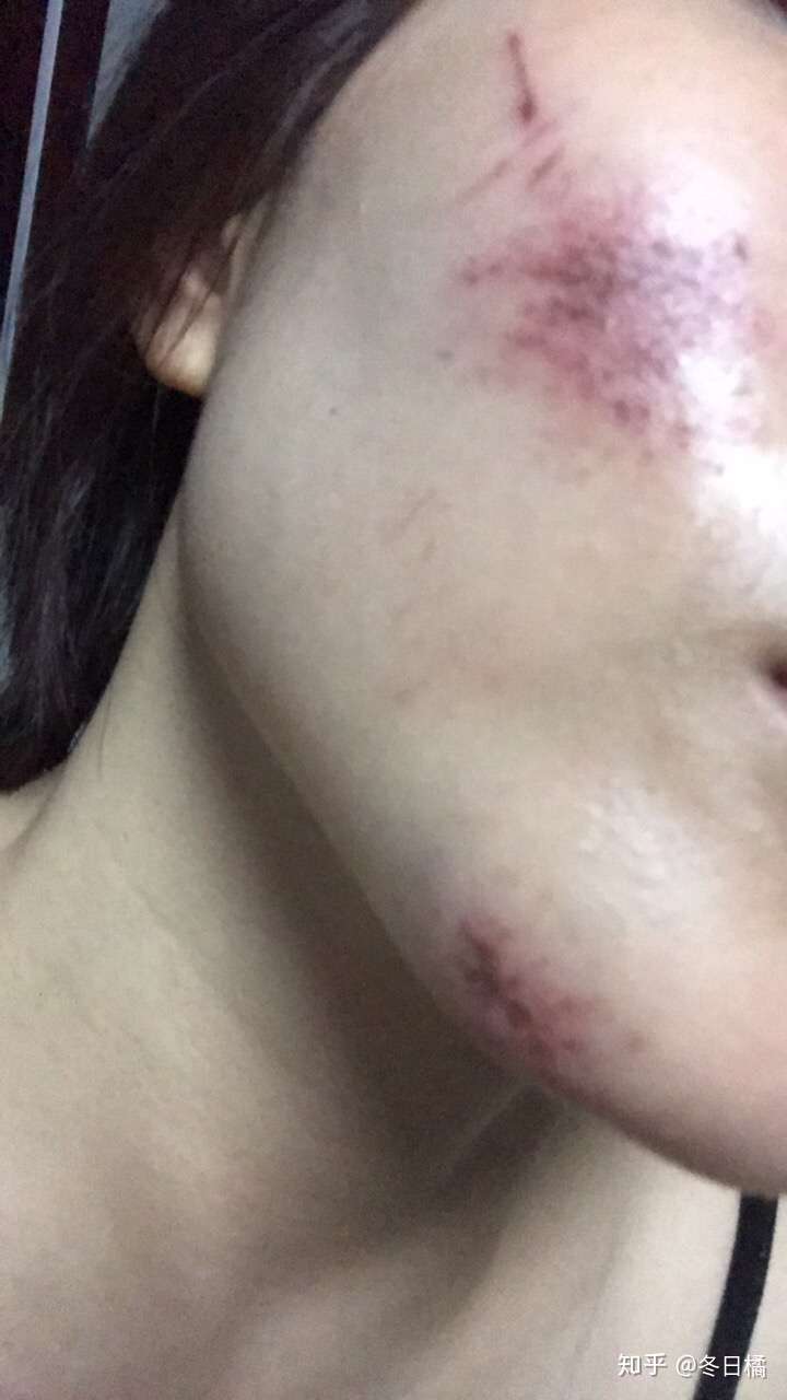 脸部擦伤结痂已经掉了但是红黑的一片怎样才能避免留疤