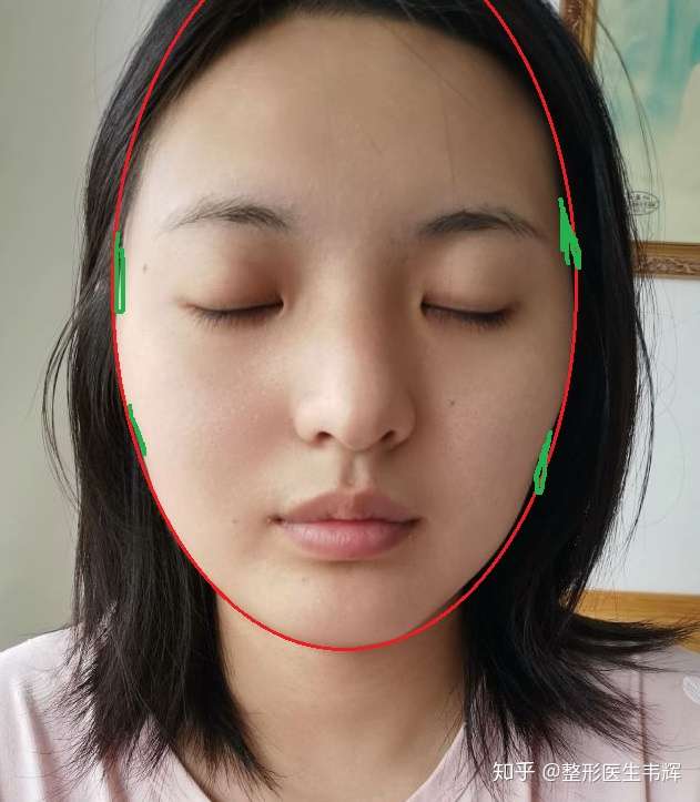 求我这是高颧骨加颧骨突出吗,脸部线条不是很流畅.