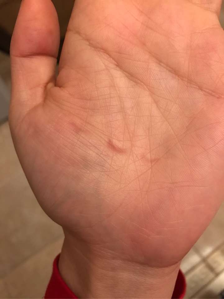 睡觉中经常会紧握住手成拳头状,醒后发现指甲掐的手心很深的印是怎么