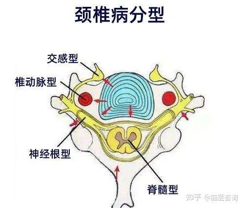 颈椎病 拍片子的那些事儿 知乎