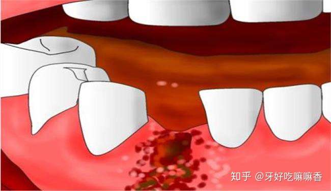 拔牙後不能吐口水一定要往肚子裡咽