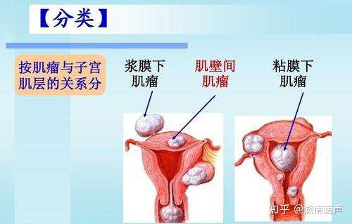 别不相信 患了子宫肌瘤的女性 身体可能会有3个表现 不要忽视 知乎