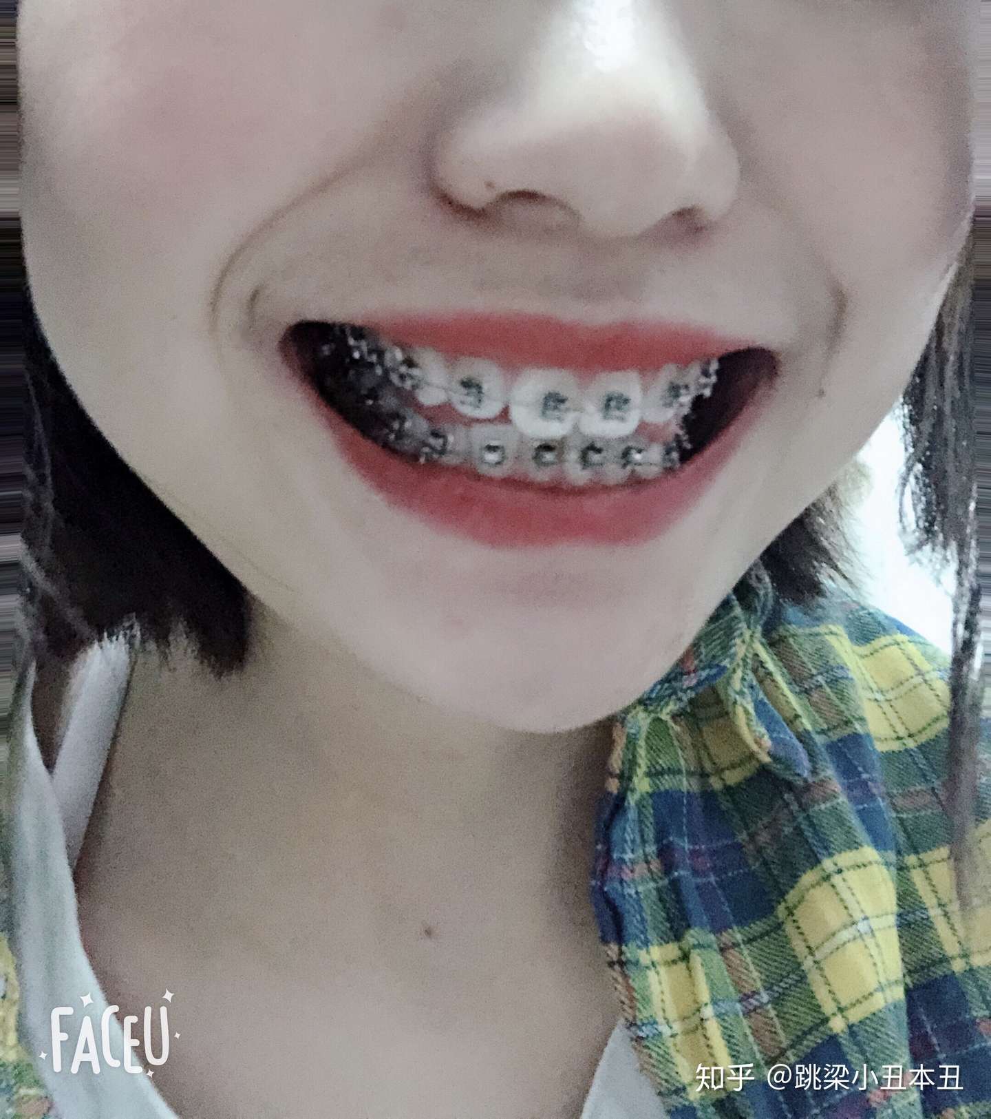 整牙日志 知乎