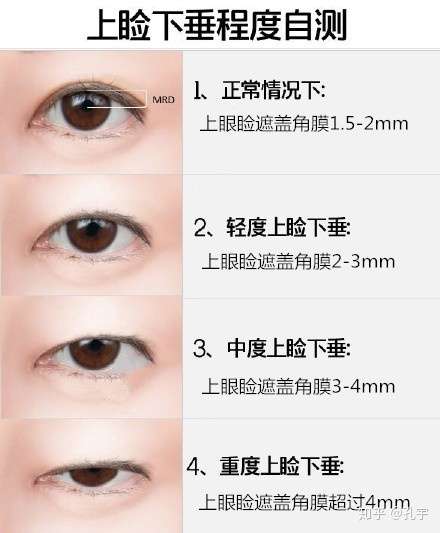 请大家来看看我这个眼尾下垂怎么救?