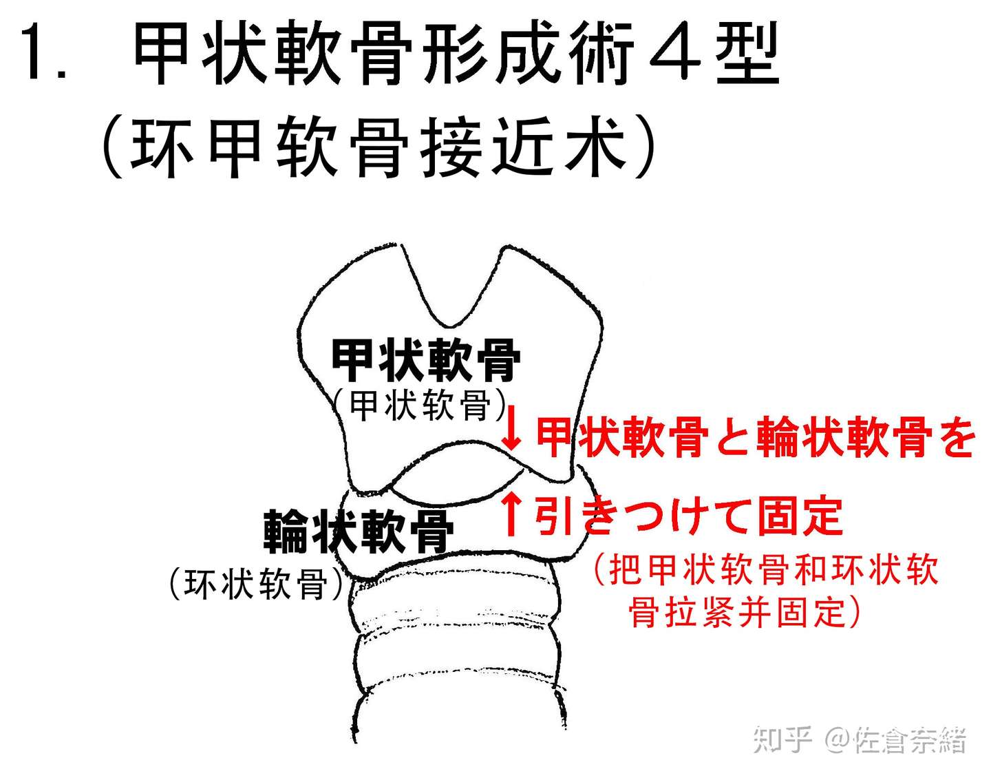 关于声带手术 翻译自日文 知乎