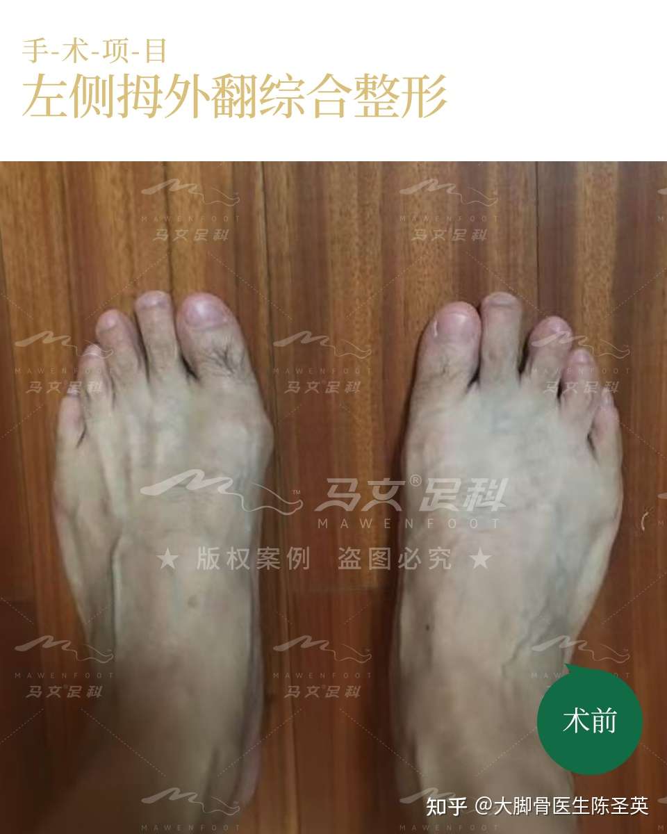 当男性遇上大脚骨怎么办 知乎