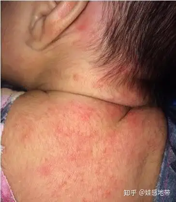 夏日炎炎痱子来袭宝宝又哭又闹怎么解决有我才甜