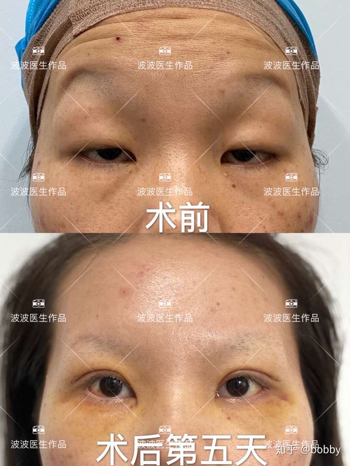 重度上睑下垂肌力为0的患者手术对比