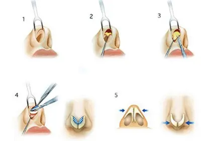 隆鼻的切口的方式,常用的就两种,一种是鼻腔内,右侧接近鼻小柱做一个
