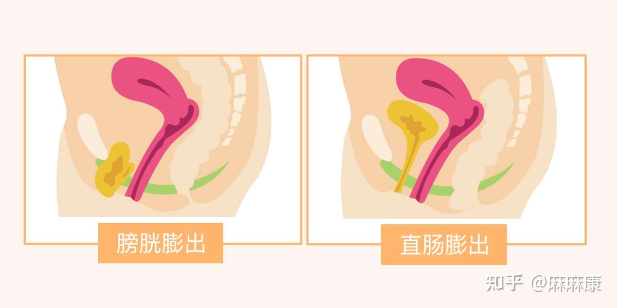 为什么产后下面会下垂 日常生活中应该要注意这3种情况 知乎