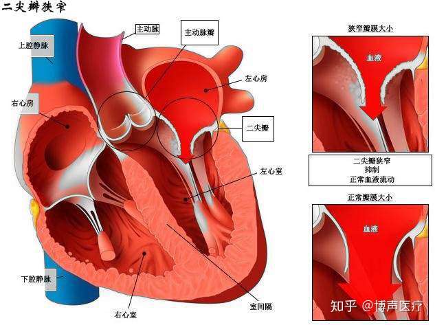 博声医疗 风湿性心脏病 风湿性心脏病的症状 知乎