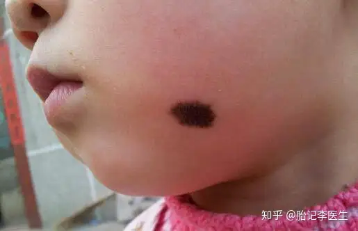 胎记有好坏之分吗？