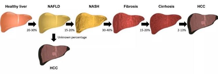 如何快速建立小鼠非酒精性脂肪肝炎（NASH，non-alcoholic steatohepatitis）模型？(图1)