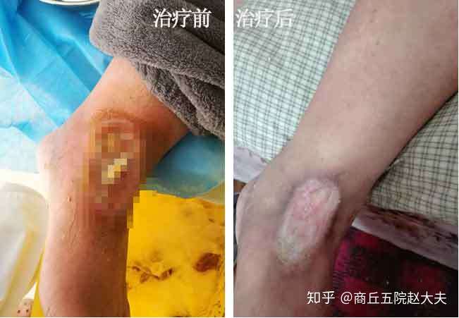 糖尿病足潰爛都露骨頭了需要截肢嗎